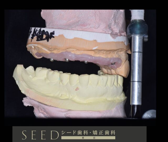 🦷checking interocclusal space for implant fixed prostheses.

上顎に4本のインプラントを埋入する治療計画です。

一枚目のスライドは模型を咬合器に付着し、2枚目の動画は被せ物を作るためのスペースがどれくらいあるか計測しています。

インプラントを埋入する前に、スペースが充分足りているかきちんと分析しているので、補綴、被せ物の作成もスムーズです。当然予後も良さそうです。

🥇世界基準の歯科治療を 日本の当たり前に

当院は、ニューヨーク大学補綴大学院を修了した米国補綴専門医(噛み合わせや審美歯科治療の専門家)による自由診療専門の歯科医院です。

自由診療による質の高い治療を受けられる歯科医院を探している方や、歯の悩みを相談したいとう方を対象に、

世界基準のシステマティックな診査診断に基づき、歯周治療や根管治療、ホワイトニングや混合歯列期からの歯列矯正介入など、患者様のニーズとご要望にお応えする総合的な歯科治療を行っております。

◯シード歯科・矯正歯科 東京
 03-6265-1732
 @seed_dental_tokyo 

◯SEEDデンタルグループ理事長 白賢
@haku_seed_dental 

◯SEEDデンタルラボ
 @seed_dentallab 

#矯正歯科#審美歯科#審美補綴#インビザライン#歯科医師による診断#歯科学生#自由診療専門 #審美歯科治療 #専門医のいる歯科医院
#dentistry #prosthodontics  #dentaltechnician #診査診断が最も重要 #radiographicguide #インプラント#overdenture #implant #補綴専門医
#歯列 #歯列矯正 #システマティック #for #深さ #ホワイトニング #審美歯科のプロ #専門家 #ジルコニア #予防歯科 #歯科衛生士 #自由診療