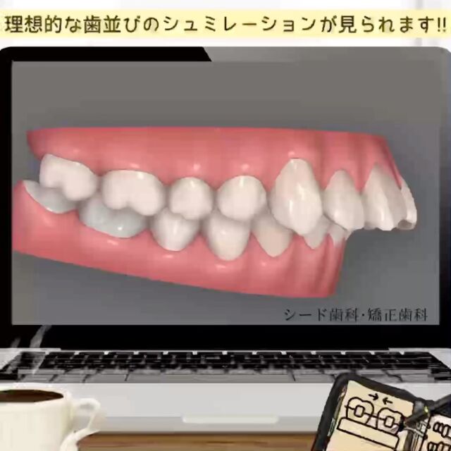 #歯科矯正 #シード歯科　#矯正

こんにちは☺︎
シード歯科・矯正歯科です

当院が取り入れております、マウスピース矯正の
「インビザライン」では治療開始前に理想的な歯並びへのシュミレーションを実際に見ていただき、患者様にご納得いただけるよう丁寧なカウンセリング行っております。

ぜひお気軽にご相談いただければと思います😌

治療費
セラミックインレー2.2万円〜
セラミッククラウン6.6万円～
ラミネートベニア9.9万円〜
部分矯正、マウスピース矯正33万円〜132万円
その他再診料、処置料が1,100円〜11,000円かかります。

⚠️リスク
噛み合わせの不調、顎関節症状、歯がしみる、セラミックの脱離、チッピング等、稀に生じる場合がございます。

*****************************

⚪︎シード歯科・矯正歯科 東京
( Tel )  03-6265-1732
( mail ) miyabi.dc@gmail.com

 @seed_dental_tokyo 

*****************************

ぜひフォローよろしくお願いします✨️
@seed_dental_nanto
@seed_dental_takaoka 

#矯正歯科  #マウスピース矯正  #部分矯正  #ワイヤー矯正 
#インビザライン#歯列矯正 #審美歯科
#審美補綴
#自由診療専門 #審美歯科治療
#ホワイトニング #ジルコニア #予防歯科
#お求めやすい価格 #美しい歯 #美容歯科